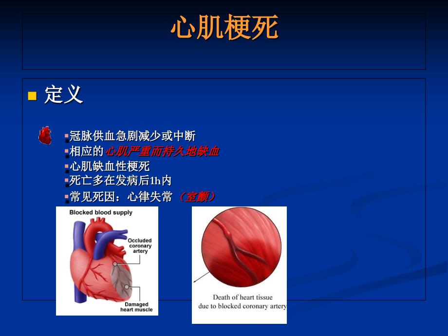 急性心肌梗死急诊PCI临床路径管理与护理_第3页