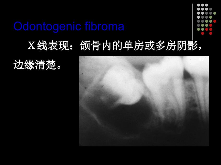 牙源性纤维瘤课件_第4页