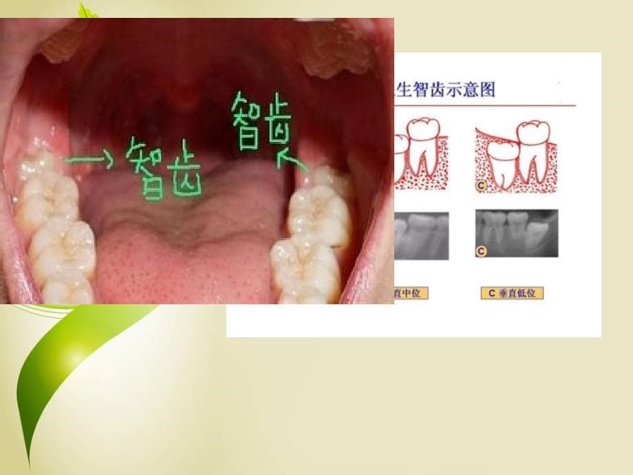 阻生齿拔除术病人的临床护理幻灯片课件_第5页