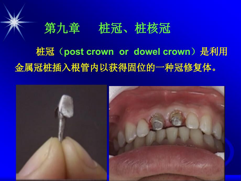 牙体缺损的患牙用桩冠来修复应该是最后一个选择按照牙体缺损由小到大的程度逻辑上应是如下这样一个修复方法的选择顺序嵌体一高嵌体一部分冠全冠一桩冠这意味着牙体缺损程度最大时才用桩冠修复课件_第1页