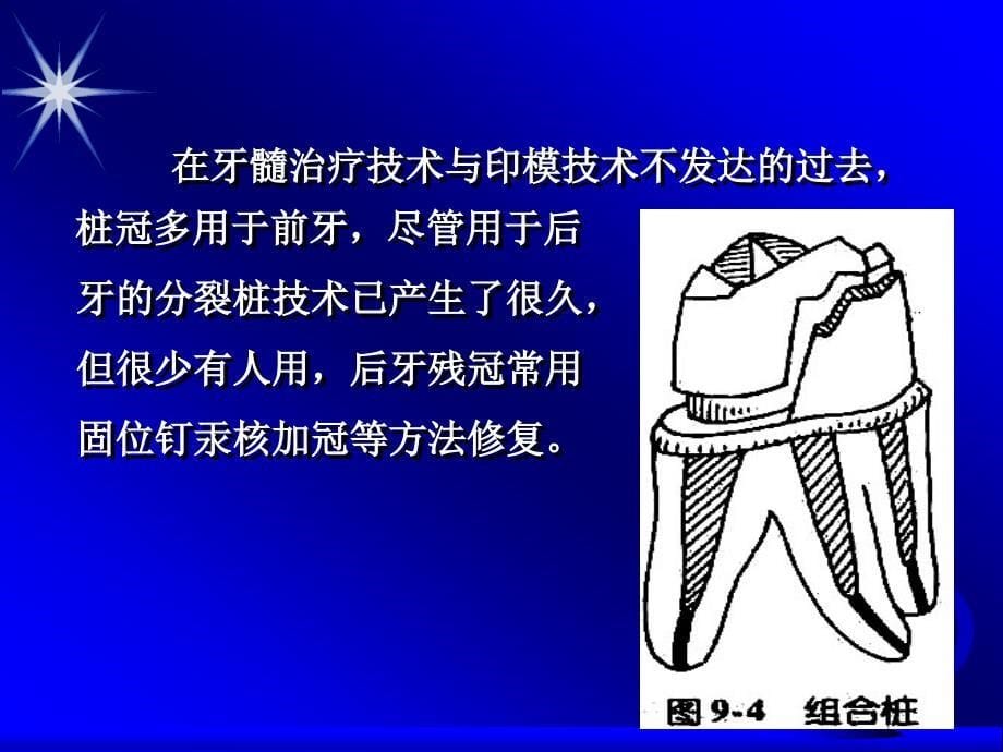 牙体缺损的患牙用桩冠来修复应该是最后一个选择按照牙体缺损由小到大的程度逻辑上应是如下这样一个修复方法的选择顺序嵌体一高嵌体一部分冠全冠一桩冠这意味着牙体缺损程度最大时才用桩冠修复课件_第5页