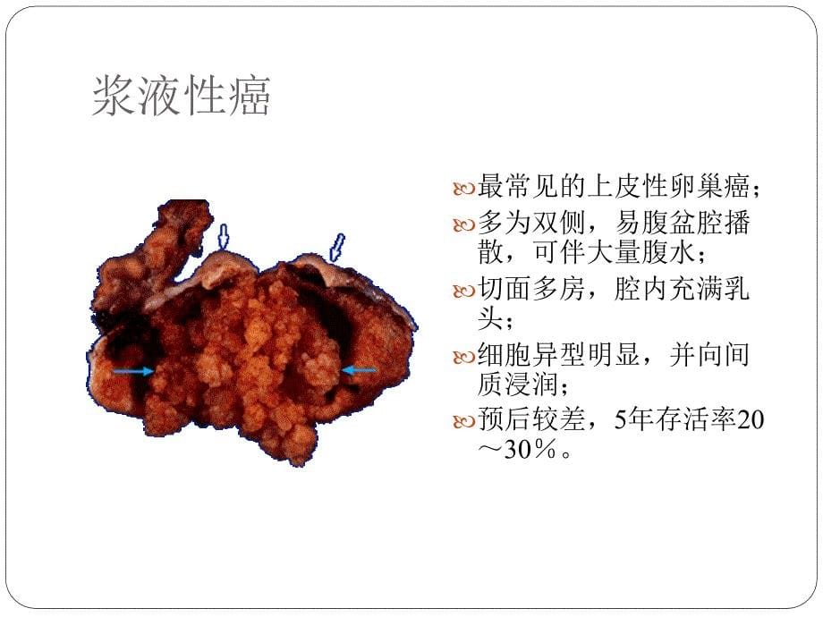 卵巢恶性肿瘤-大学课件_第5页