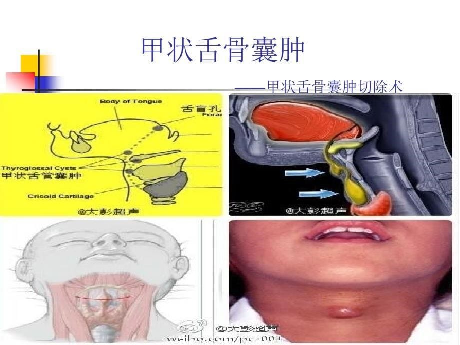 舌骨囊肿切除术课件_第5页