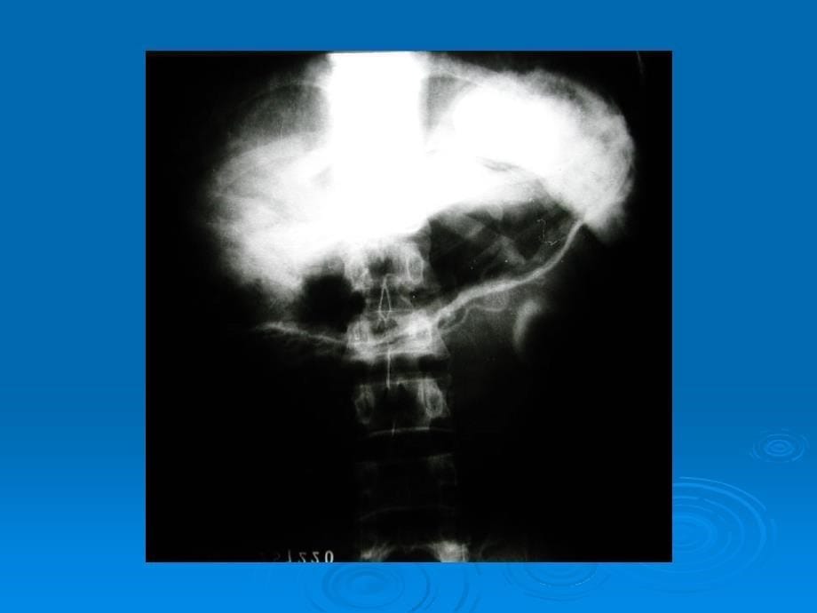 腹腔动脉造影课件_第5页