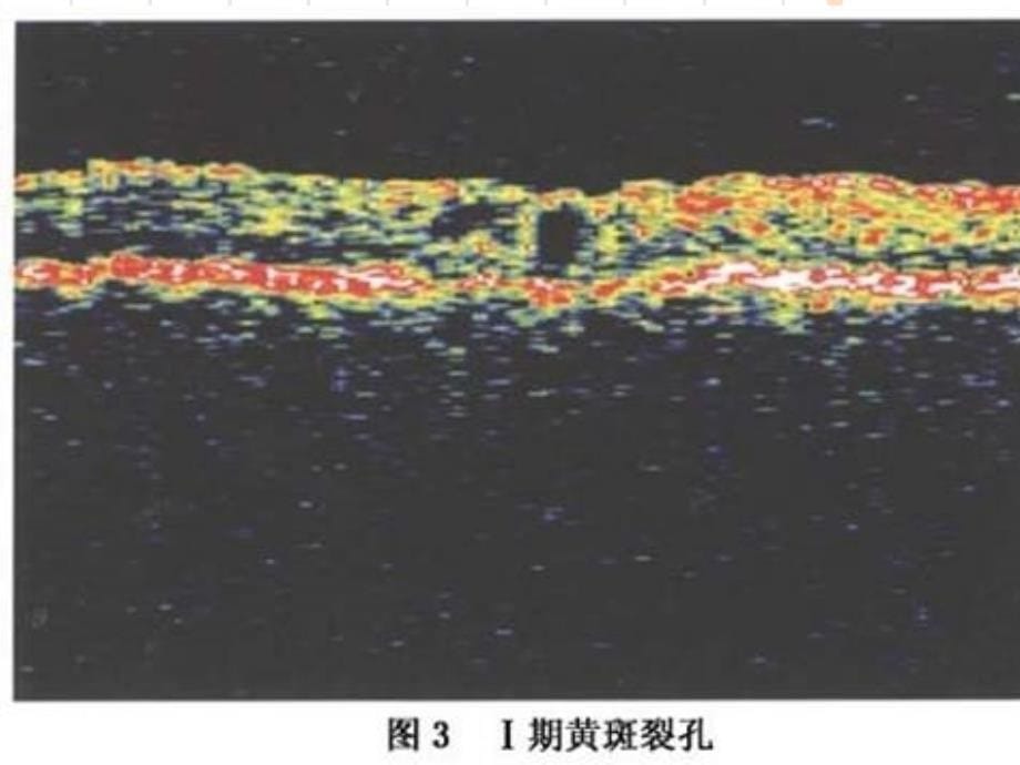 黄斑裂孔性视网膜脱离护士业务学习课件_第5页