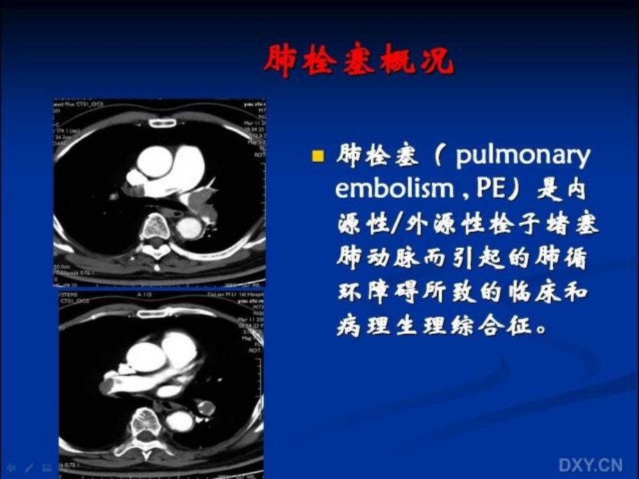 肺栓塞肺梗死课件_第2页