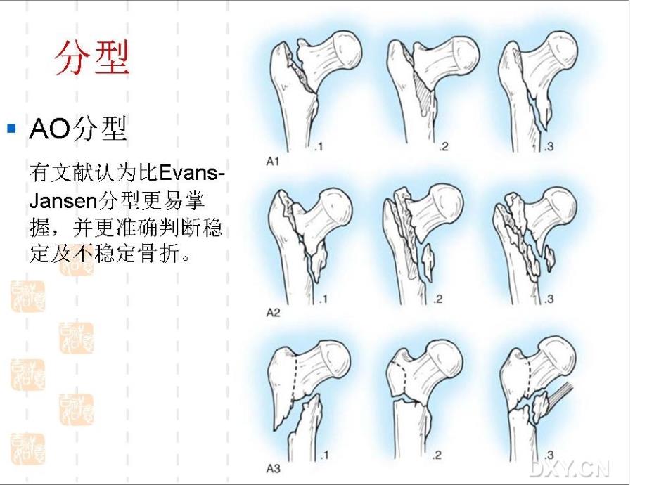 股骨粗隆间骨折的内固定治疗的选择及策略课件_第2页