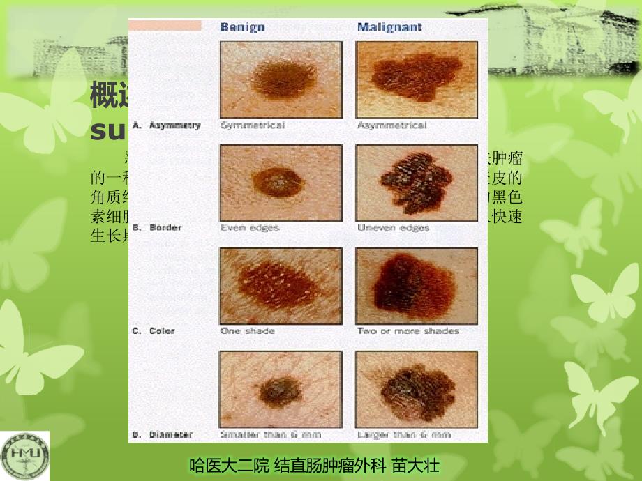 肛管直肠恶性黑色素瘤课件_第4页