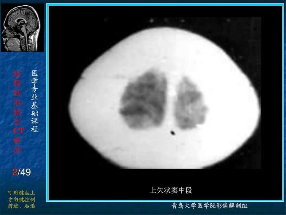 脑膜脑池脑室的ct解剖_1课件_第2页