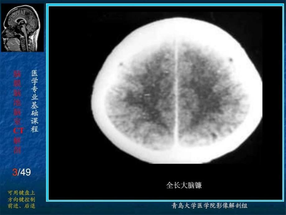 脑膜脑池脑室的ct解剖_1课件_第3页