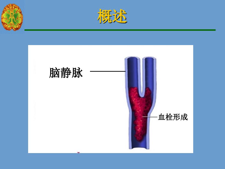 脑静脉系统血栓形成._第3页