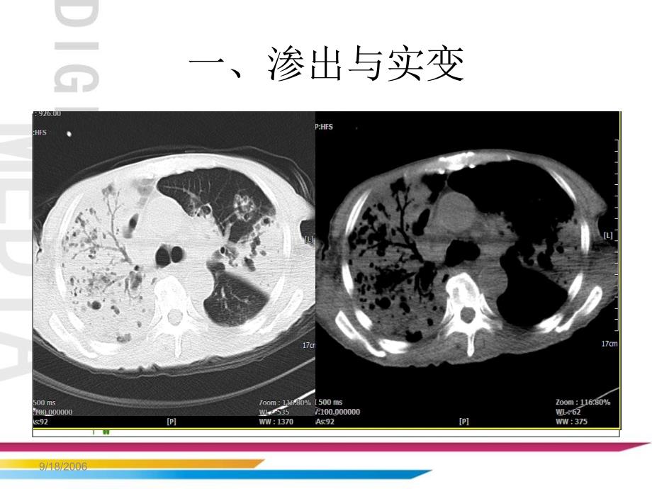 肺部基本病变的ct表现课件_第4页