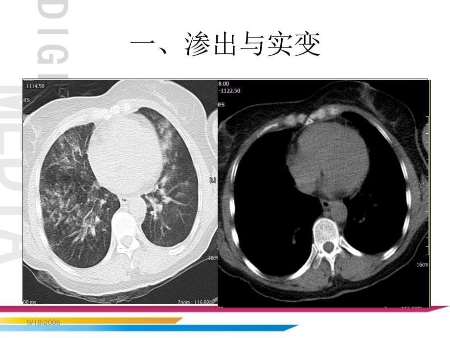 肺部基本病变的ct表现课件_第5页