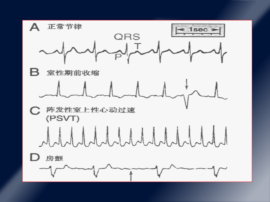 第二十三章抗心律失常药课件_第3页