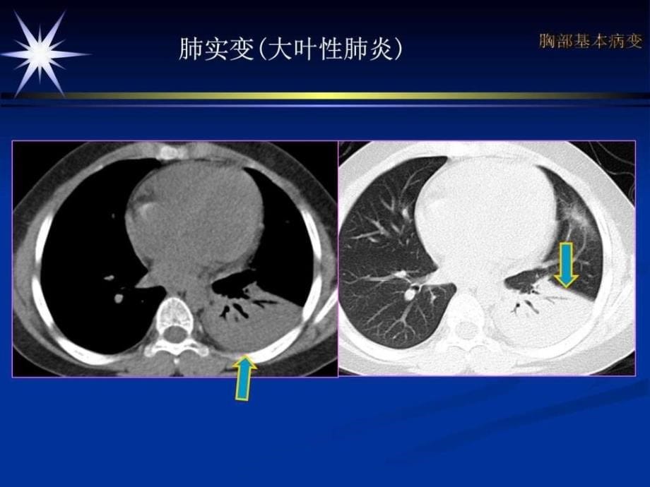 肺部基本病变ct图文课件_第5页