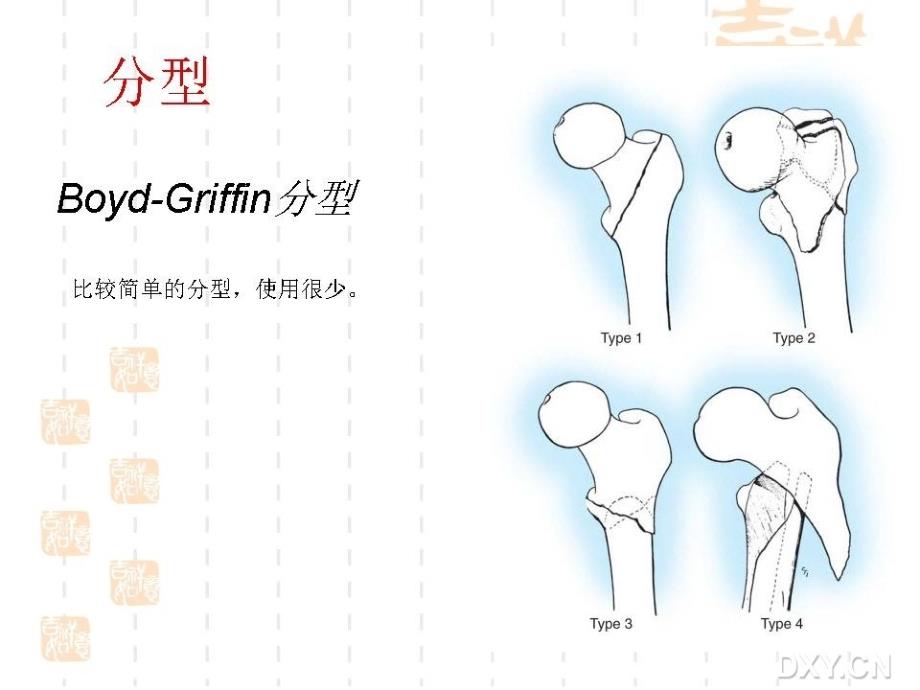 股骨近端骨折（粗隆间下）内固定选择及策略课件_1_第4页