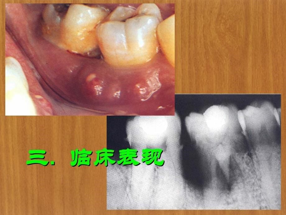 第十一章牙周炎伴发病变课件_第5页