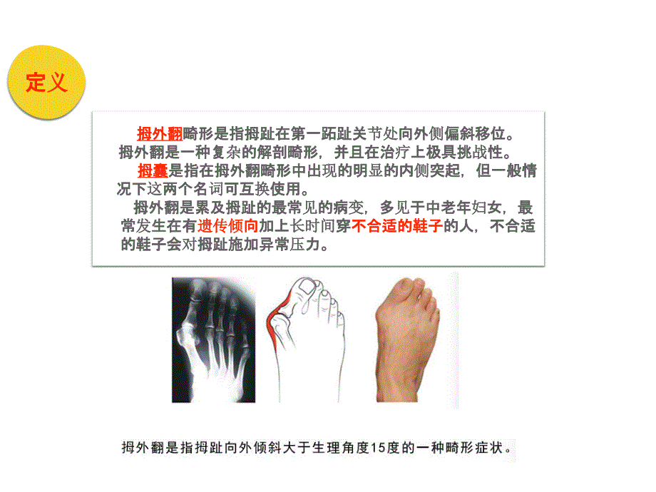 拇外翻图文课件_第3页