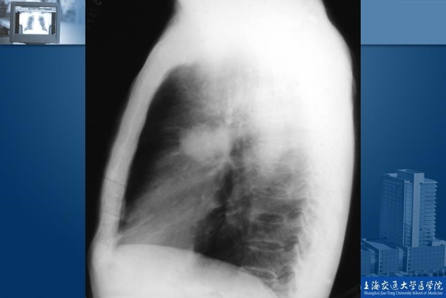 肺癌影像学诊断课件_第5页