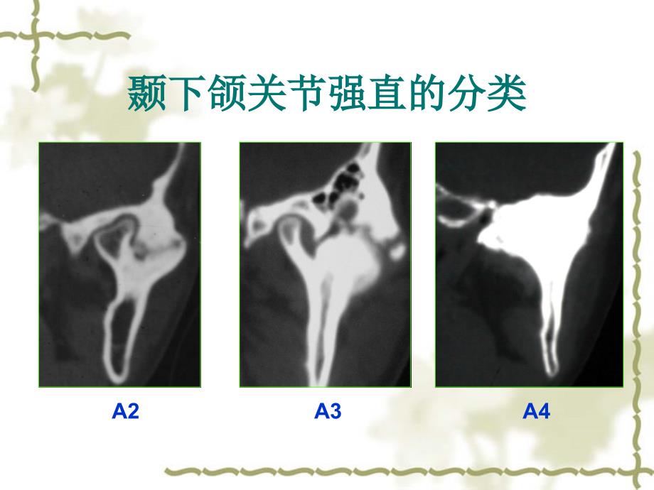 第四节杨驰颞下颌关节强直的诊治经验课件_第4页