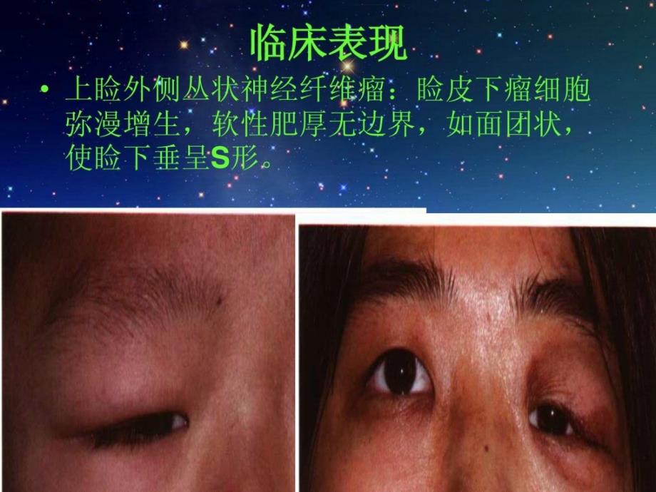 精华神经纤维瘤病课件_第4页