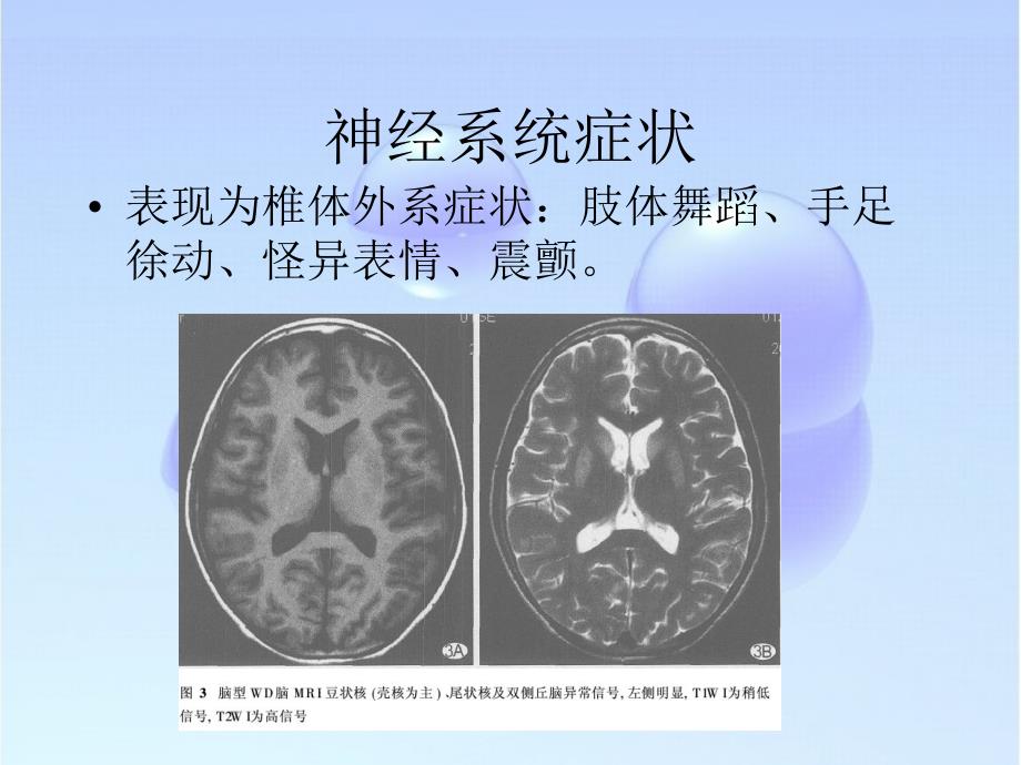 肝豆状核变性（wilson病）课件_第4页