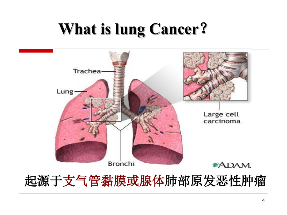 肺_  癌课件_第4页