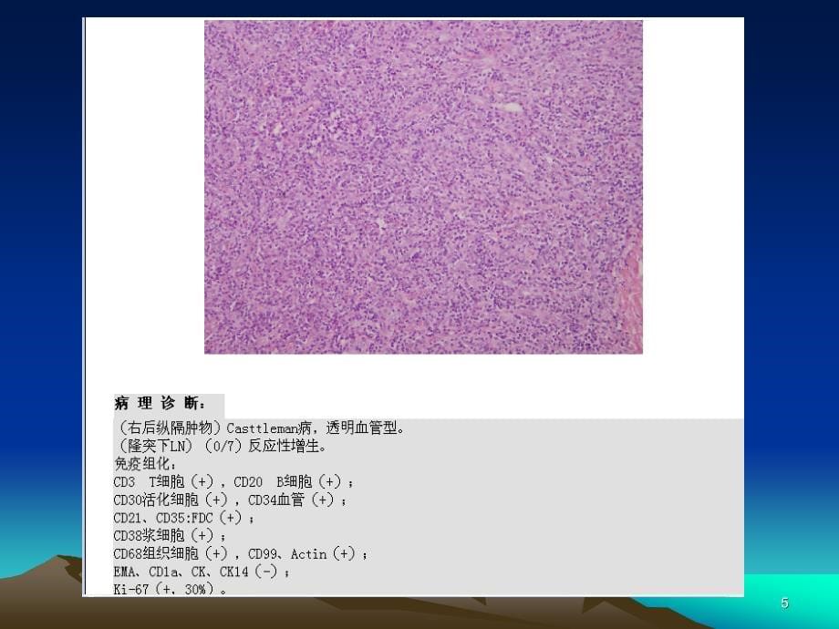 病例随访纵隔巨淋巴增生症PPT课件_第5页