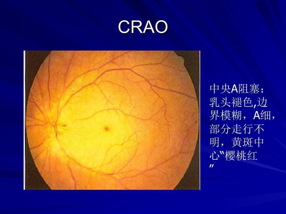 视网膜血管病眼底病课件_第5页