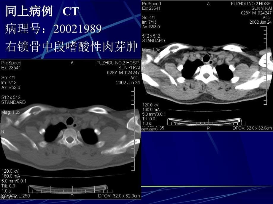 瘤样病变之（骨囊肿5）课件_第5页