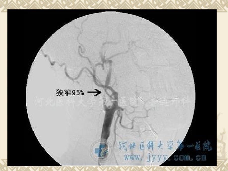 颈动脉内膜剥脱术术前及术后的护理课件_第5页