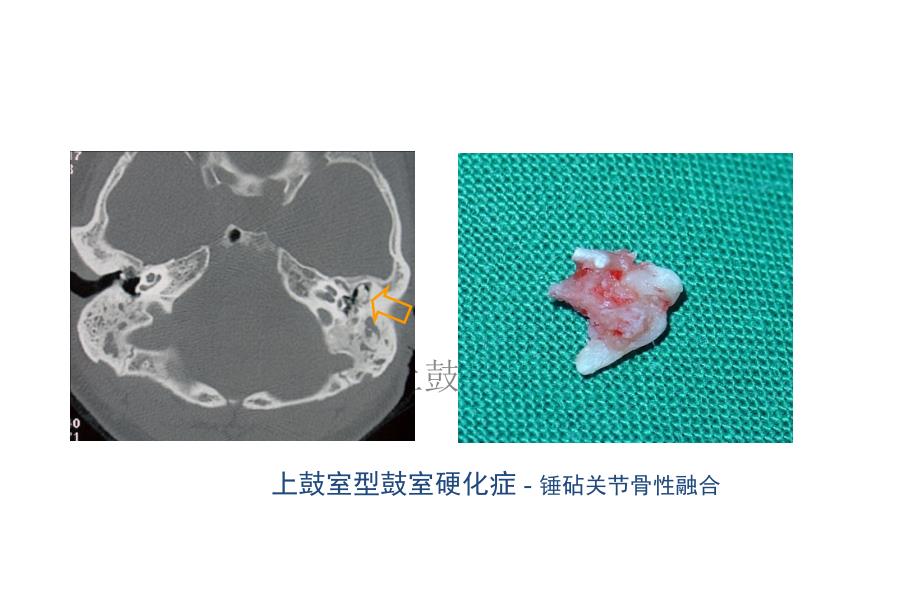 颞骨影像（ct）3炎症课件_第4页