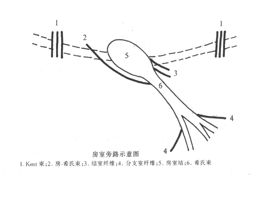 有关预激综合征课件_第4页