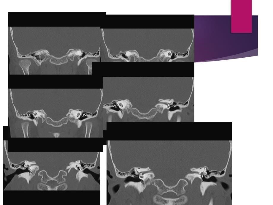 颞骨解剖及中耳炎ct诊断课件_第5页