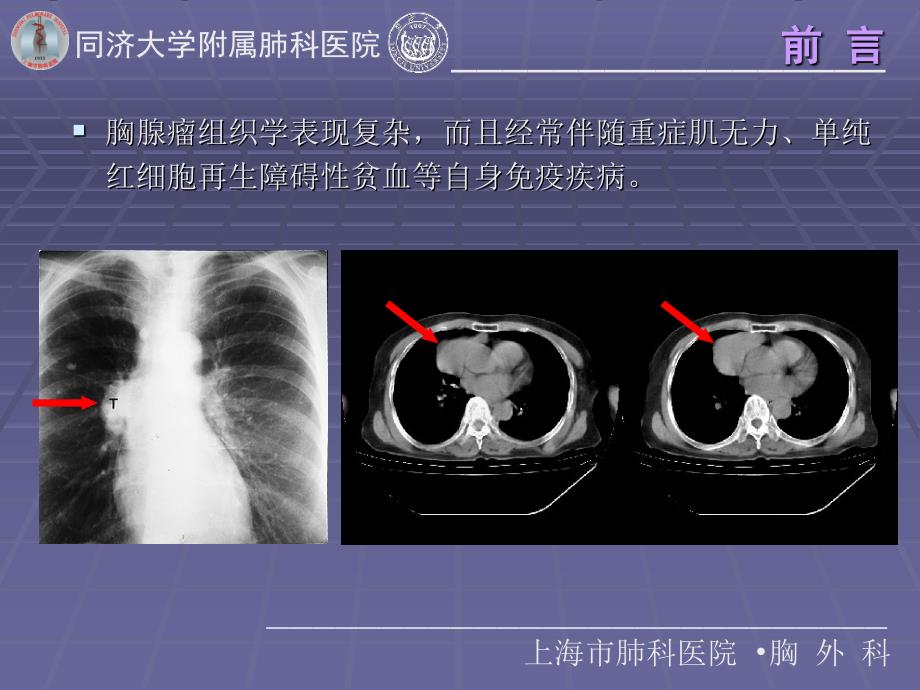 例胸腺瘤who分型及masaoka分期的回顾研究宋楠课件_第3页