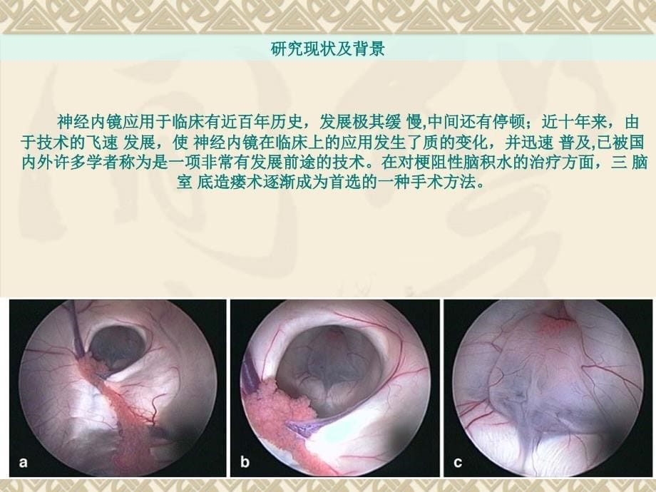 梗阻性脑积水硕士开题报告精品课件_第5页