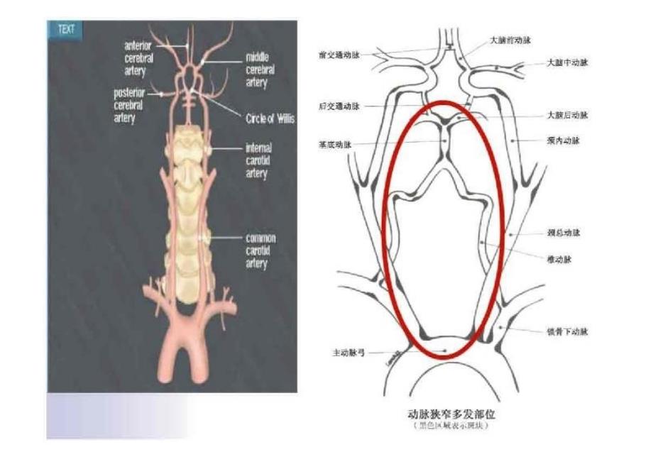 眩晕与后循环缺血课件_第3页