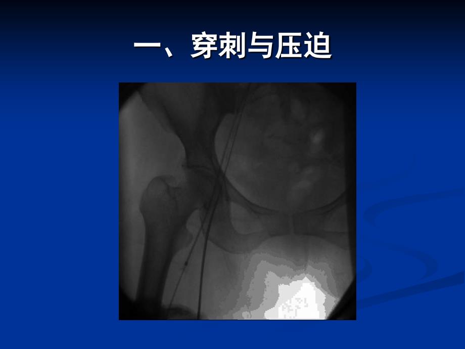 房间隔缺损介入治疗技术及规范化操作课件_第4页