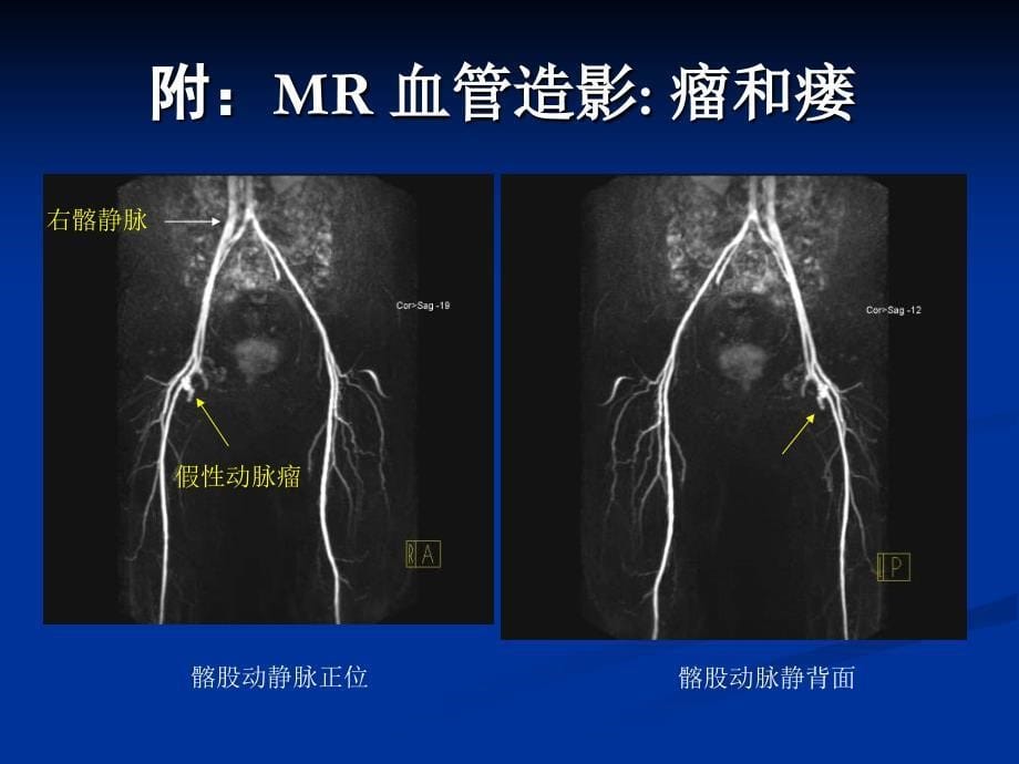 房间隔缺损介入治疗技术及规范化操作课件_第5页