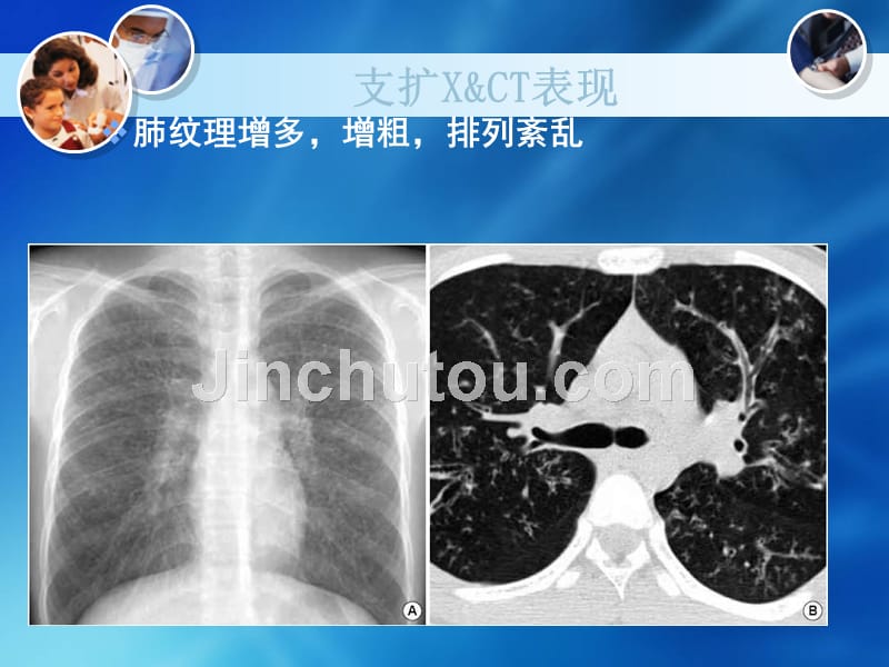 支气管扩张症影像表现课件_第4页