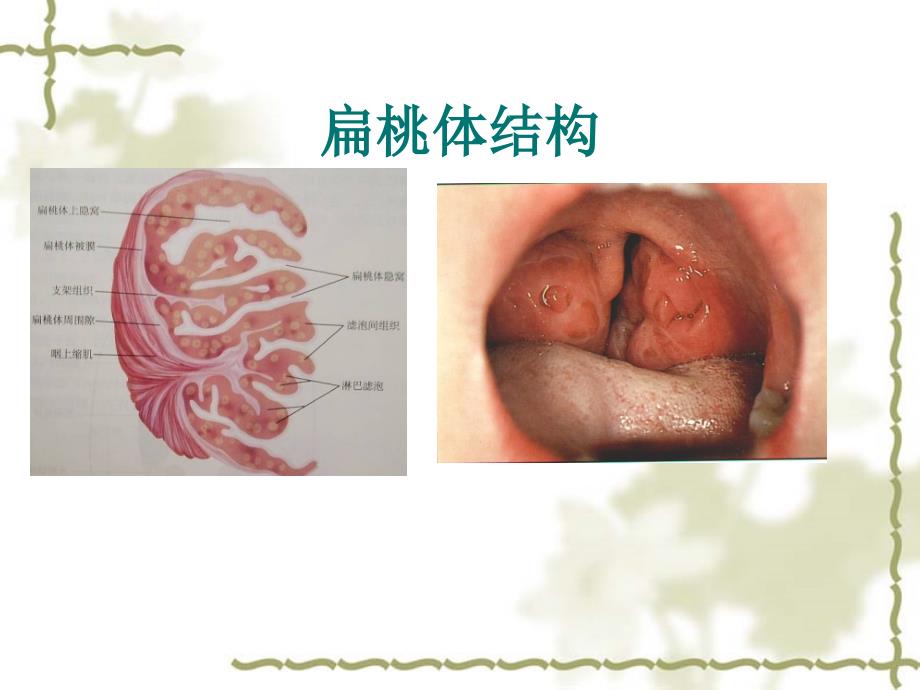 急性扁桃体炎图文课件_第4页