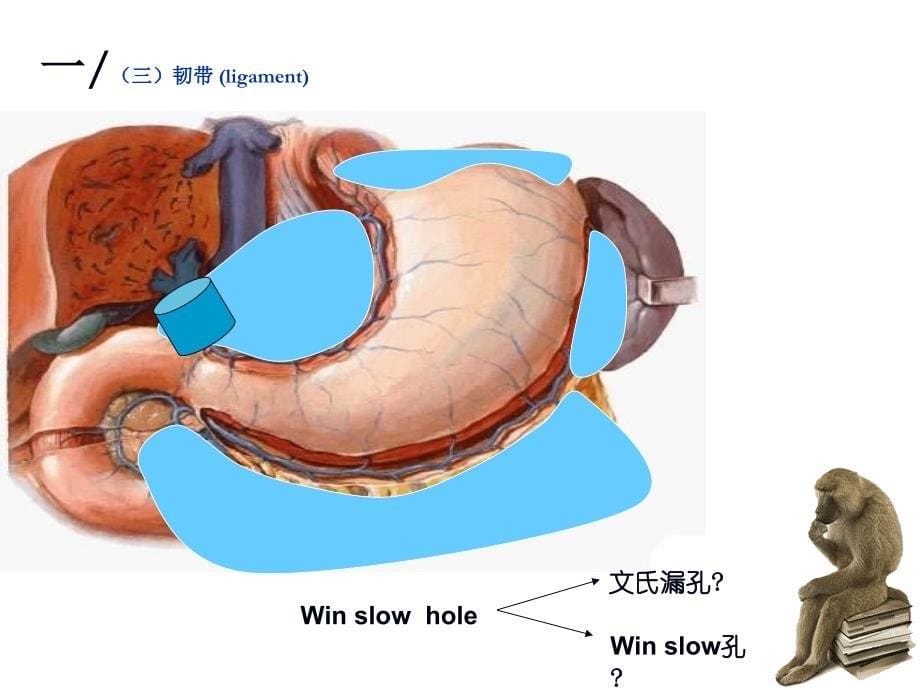 十二指肠憩室课件_1_第5页