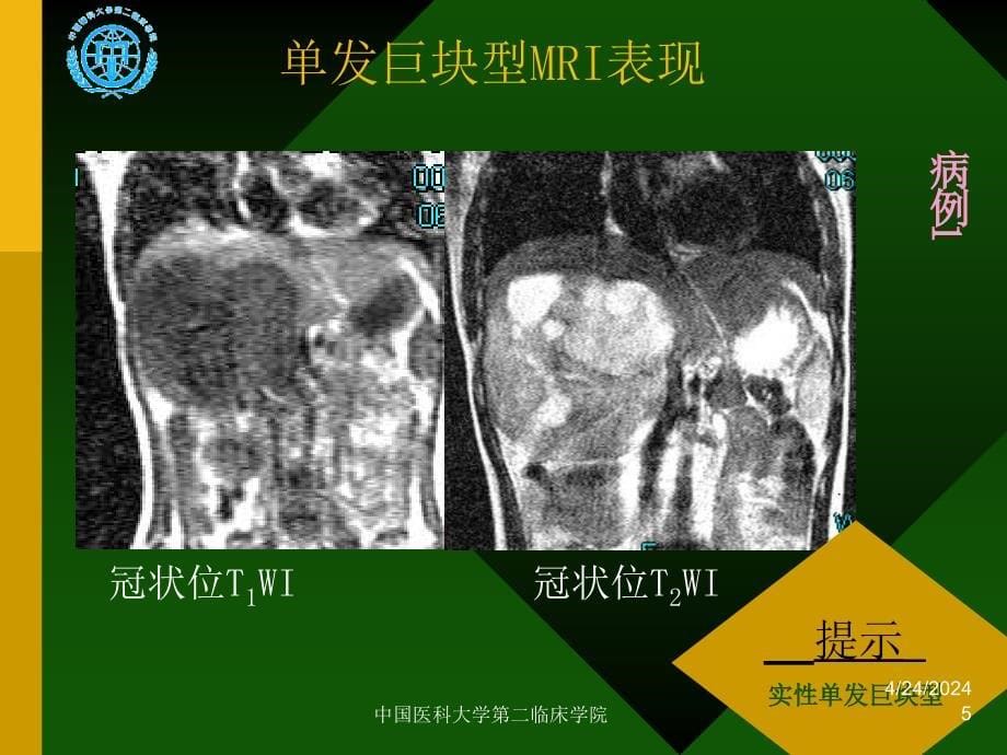 小儿肝脏间叶性错构瘤课件_第5页