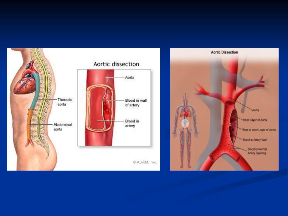 主动脉夹层动脉瘤 ppt课件_第4页