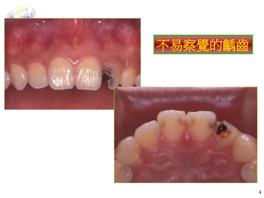 精品不易察觉的龋齿课件_第4页