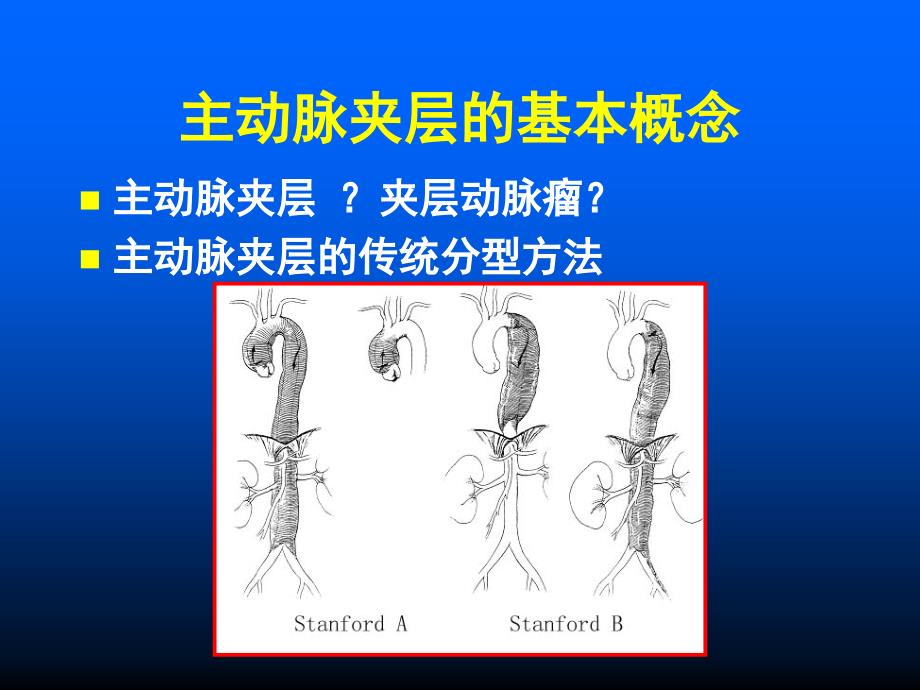 主动脉夹层的外科分型及治疗对策课件_第2页