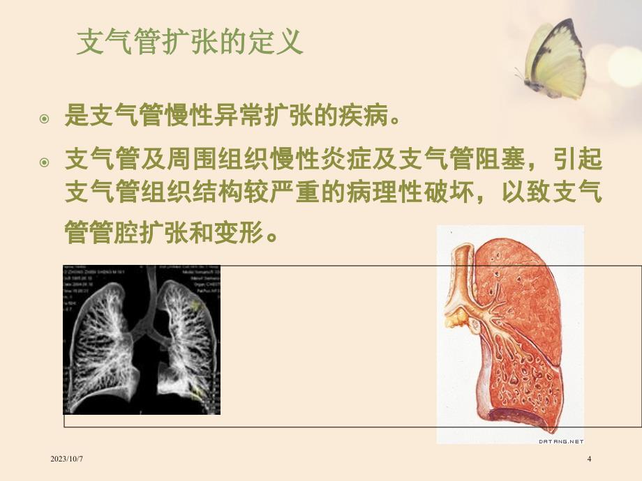 支气管扩张疾病查房课件_第4页