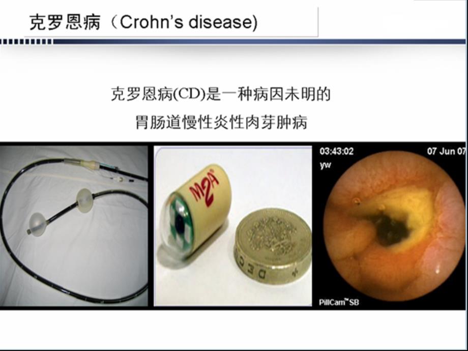 克罗恩病诊治 ppt课件_第2页