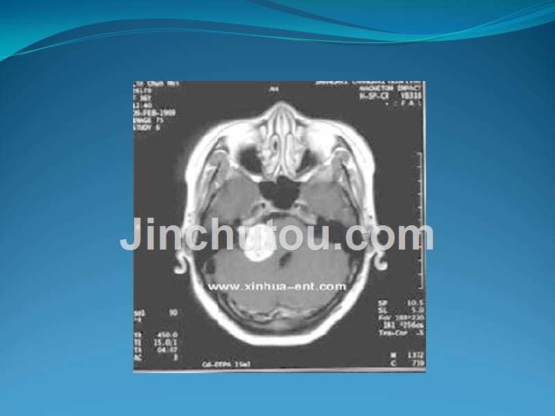 听神经瘤课件_4_第4页