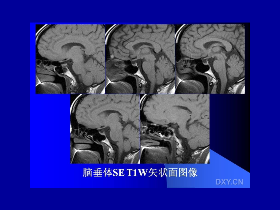 临床医学垂体瘤的mri诊断与鉴别诊断课件_第3页